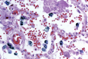 Image: Light micrograph of a section through a malignant melanoma, showing red blood cells (red), connective tissue and blood vessel walls (purple) and macrophages (blue) (Photo courtesy of Steve Gschmeissner / Science Photo Library).